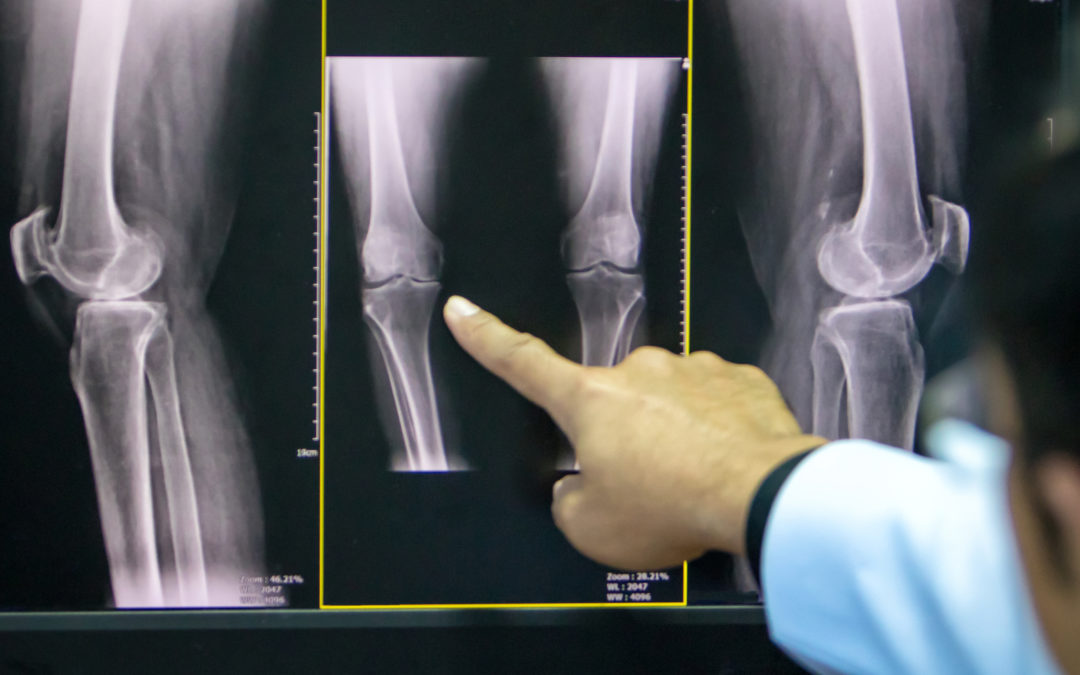 Prolotherapy