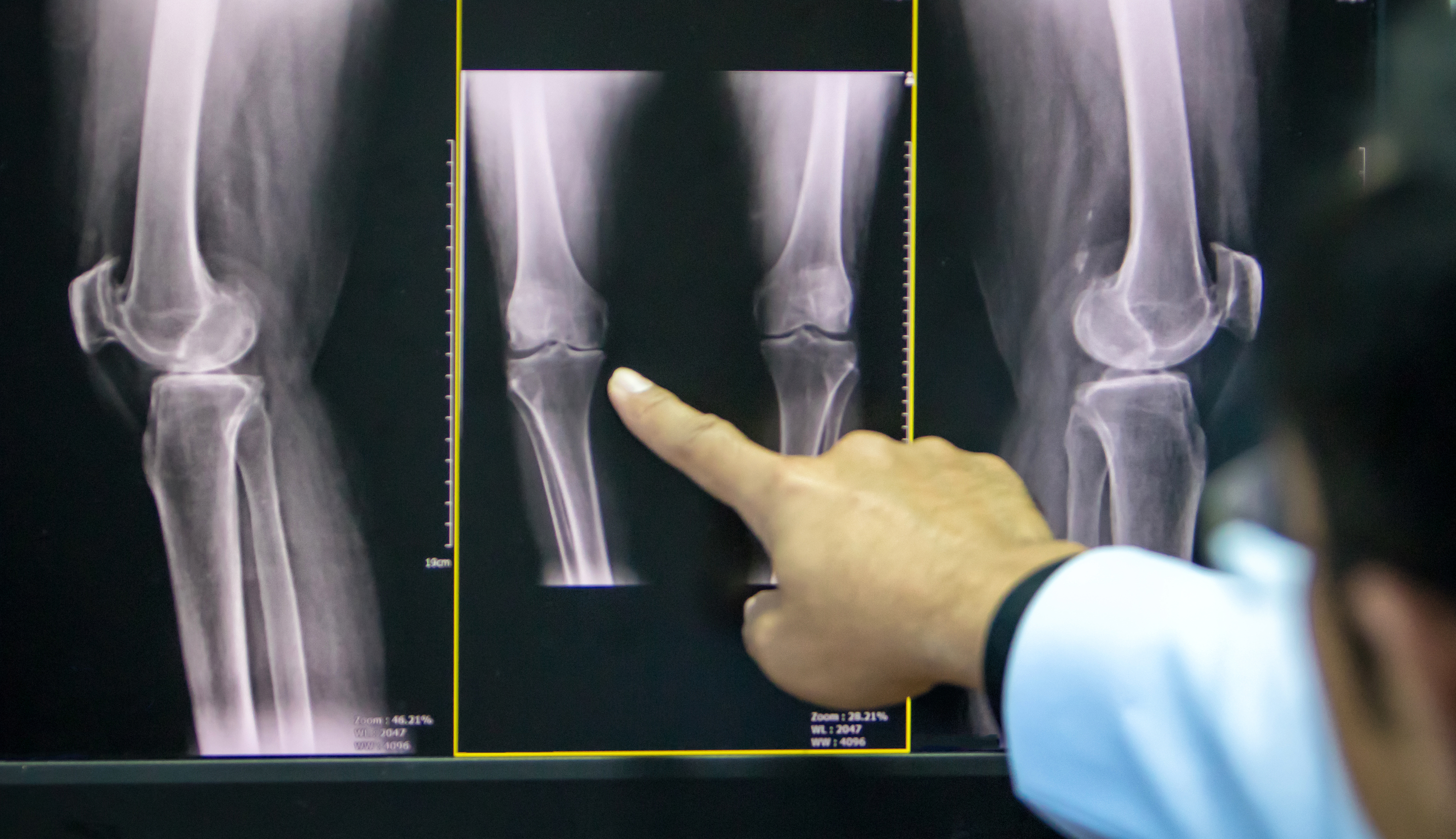Рентгеновский снимок коленного сустава в норме